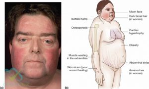 Tác dụng không mong muốn của corticoid