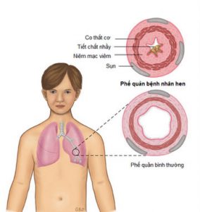 22 thuoc can thiet cho nguoi benh hen