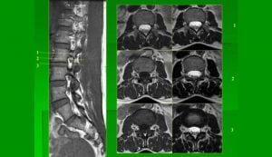 MRI thoát vị đĩa đệm