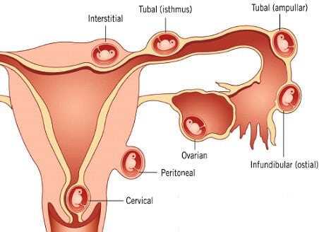 Phương pháp điều trị chửa ngoài tử cung và các biện pháp phòng ngừa.