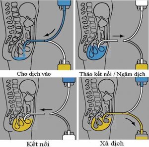 Lọc màng bụng liên tục ngoại trú