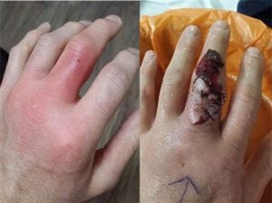 24 nhiễm trùng vết thương