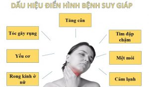 Suy giáp ở người lớn