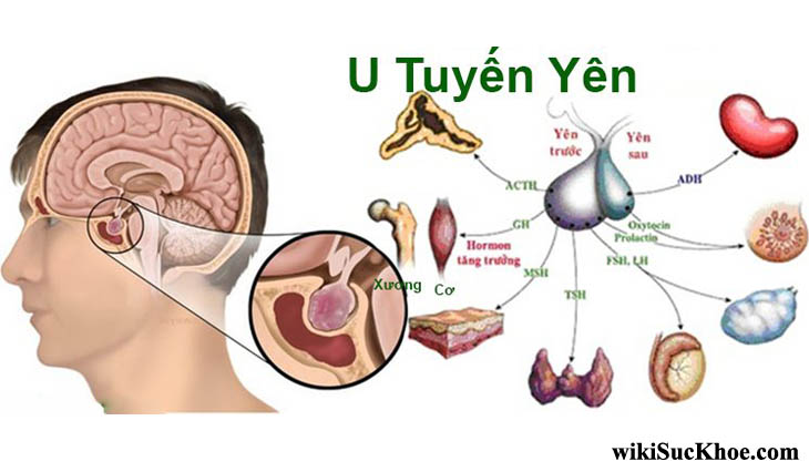 Xạ trị là phương pháp điều trị u tuyến yên hiệu quả?
