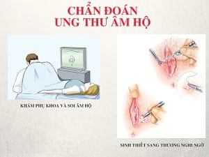 ung thu am ho 1