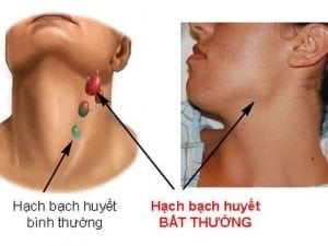 viêm hạch bạch huyết