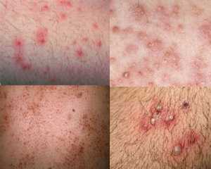 Viêm nang lông (Folliculitis)