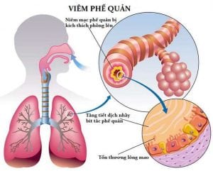 Viêm Phế Quản Cấp