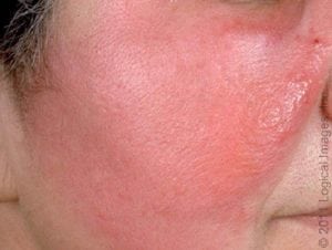 Viêm tấy lan tỏa