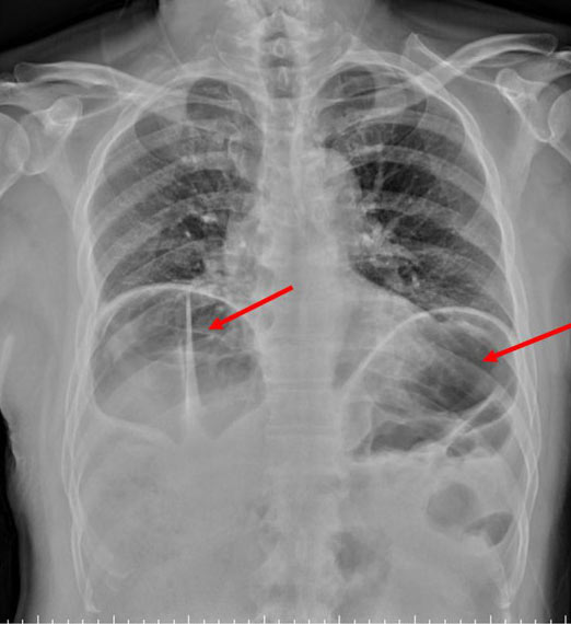 Dấu hiệu Chilaiditi trên X quang phổi