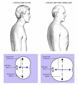 Lồng ngực hình thùng (Barrel Chest)