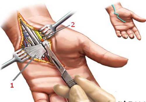 Phẫu thuật Hội chứng ống cổ tay (Carpal tunnel syndrome)