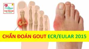 Tiêu chuẩn chẩn đoán bệnh Gout theo ACR/EULAR 2015