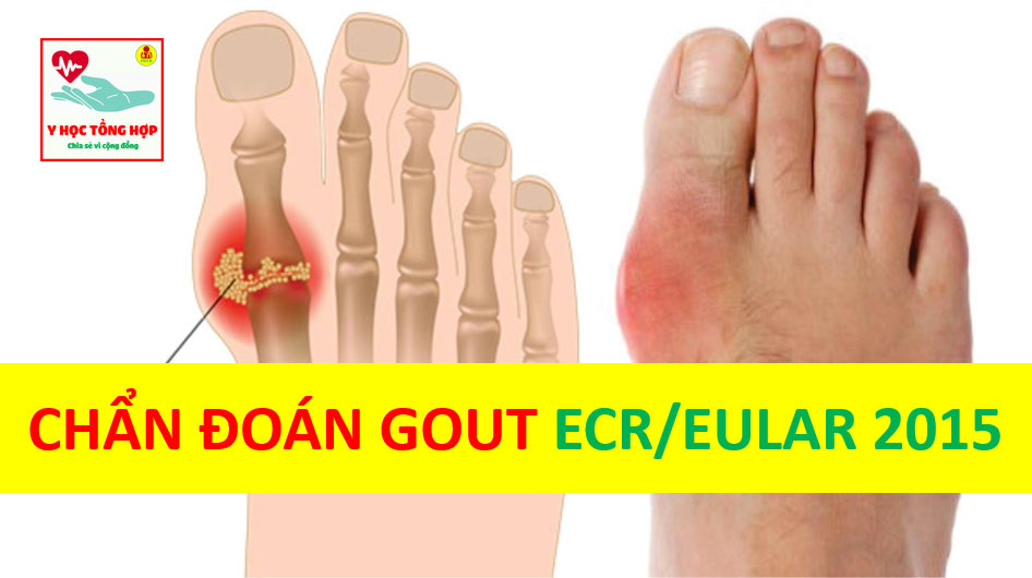 Tiêu chuẩn chẩn đoán bệnh Gout theo ACR/EULAR 2015
