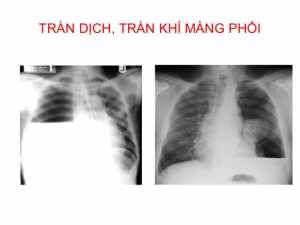 Tràn khí màng phổi