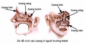 Viêm mũi xoang cấp