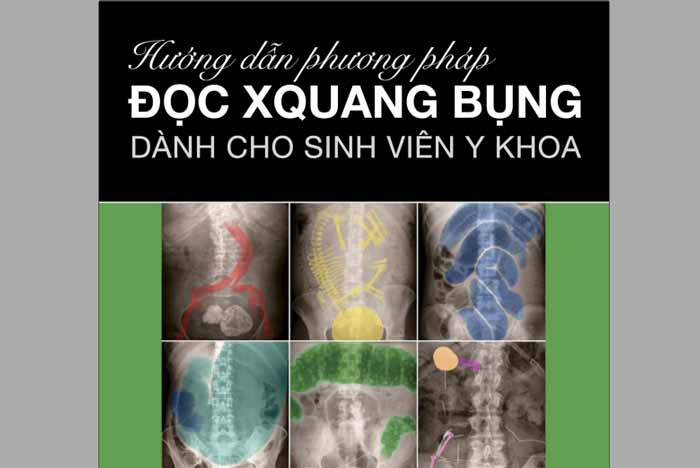 Abdominal X-Rays for Medical Students PDF Tiếng Việt - BS. Đỗ Tiến Sơn, Hướng dẫn phương pháp đọc X Quang bụng dành cho sinh viên y khoa