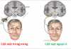 Phân biệt liệt dây thần kinh VII trung ương và liệt dây VII ngoại vi