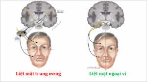 21 Phân biệt liệt dây thần kinh VII trung ương và liệt dây VII ngoại vi