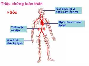 Sốc giảm thể tích