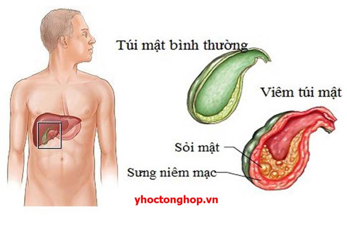 Bài giảng viêm túi mật được thực hiện bởi ai?
