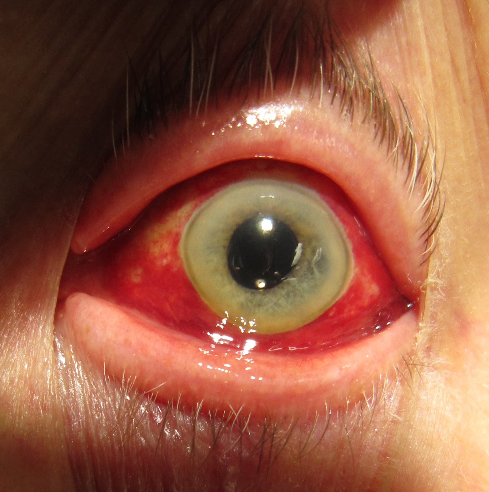 Human eye showing subconjunctival hemorrhage