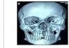 Hoại xương tử hàm sau Covid-19 có đáng lo ngại?