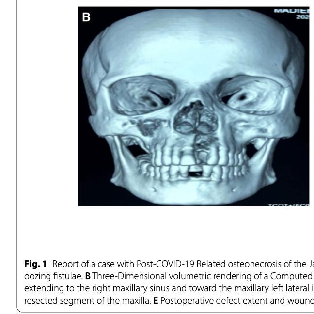 Hoại xương tử hàm sau Covid-19 có đáng lo ngại?